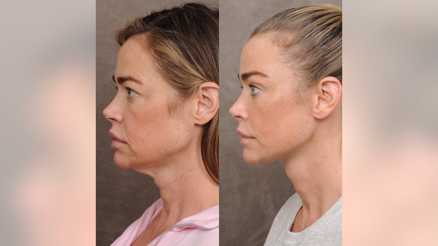 denise-richards-facelift-side-profile.jpg