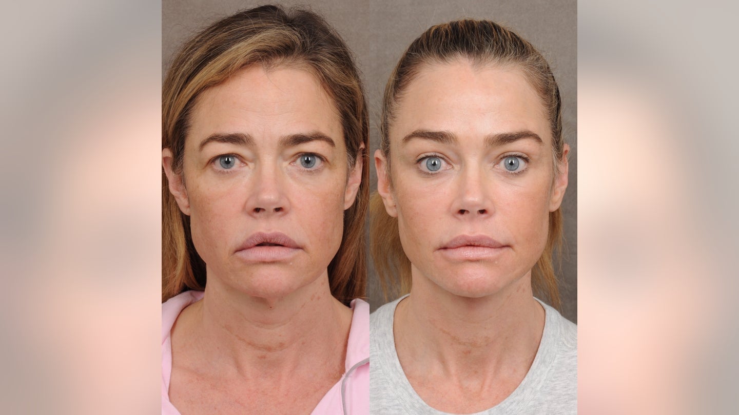 denise-richards-facelift-forward.jpg