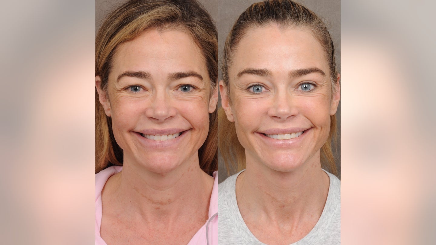 denise-richards-facelift-smiling.jpg