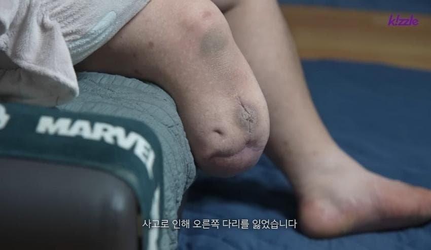 다리가 절단된 조선업 청년의 현실..jpg