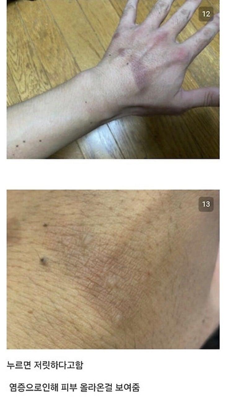 28932.jpg 붉은사슴뿔버섯을 본인 몸에 실험한 일본인.jpg