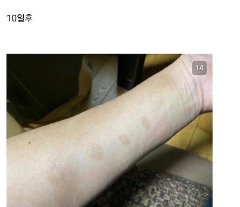 28933.jpg 붉은사슴뿔버섯을 본인 몸에 실험한 일본인.jpg