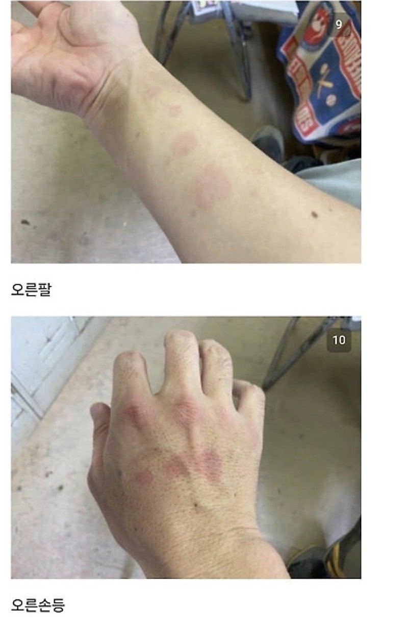 28930.jpg 붉은사슴뿔버섯을 본인 몸에 실험한 일본인.jpg