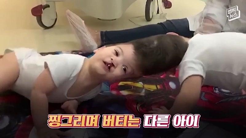 33시간 수술 끝에 얼굴 본 쌍둥이.jpg